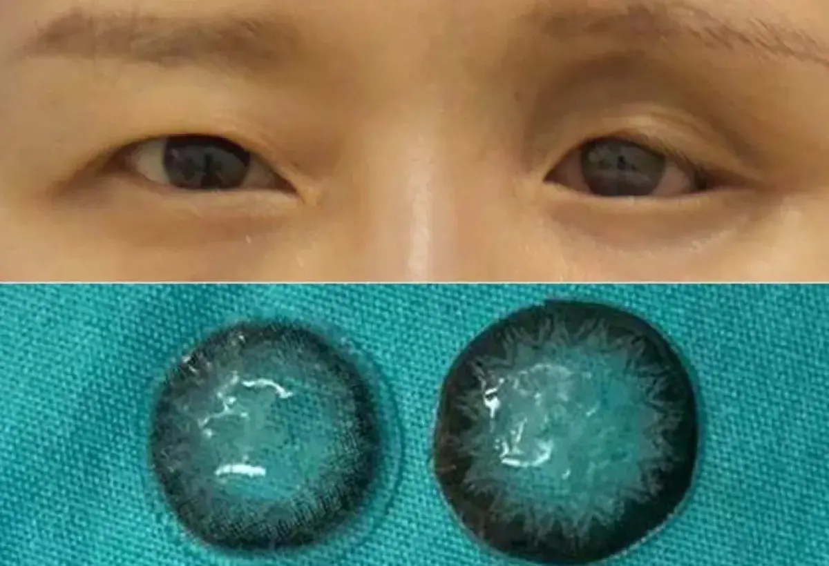 Five contact lenses found stuck behind a woman’s eyeball