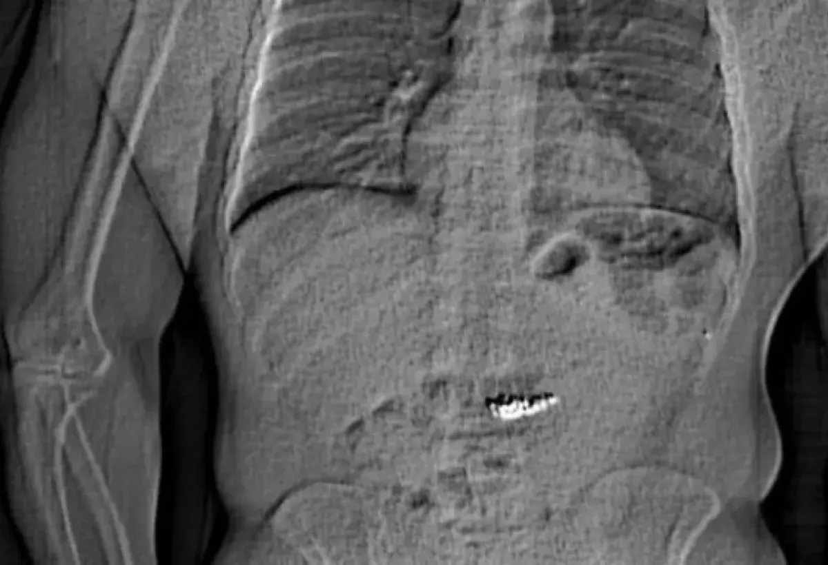 Thief swallows Tiffany earrings to avoid arrest